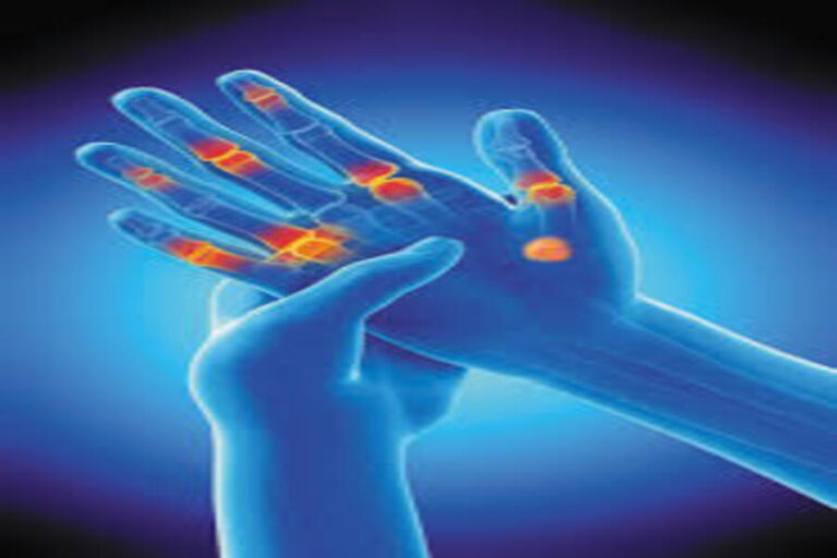 Tips to prevent Rheumatoid arthritis