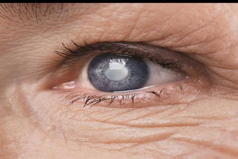 Important Advice That Will Help You Avoid Cataracts 