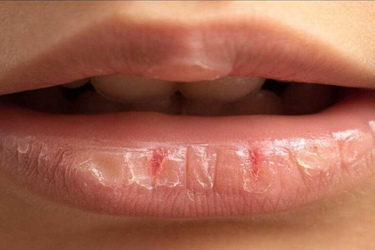 Effective Ways To Prevent Dry Lips 