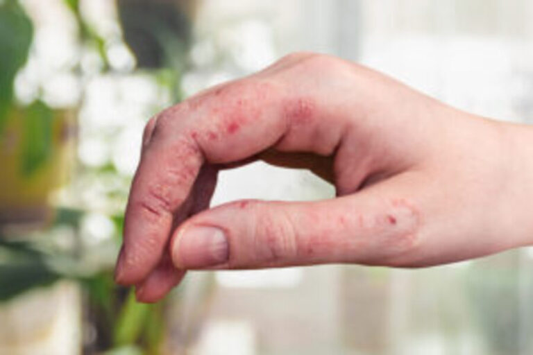 Psoriasis: Understanding the condition and effective treatment approaches