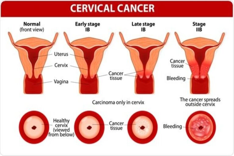 Tips that will help you to prevent cervical cancer