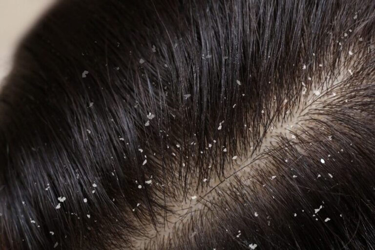 Natural Remedies to Help You Get Rid of Dandruff
