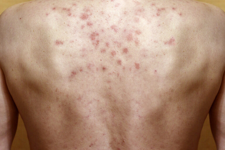 Diet for patients suffering from chicken pox 