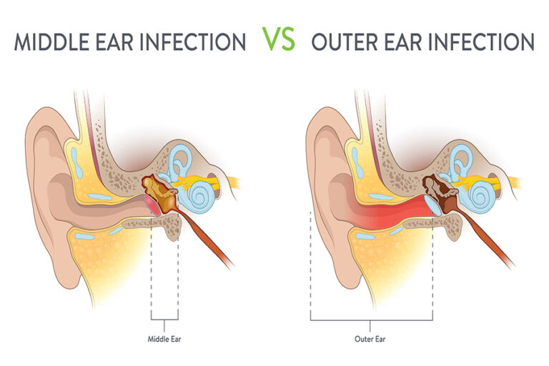 Important Tips to Prevent Ear Infection