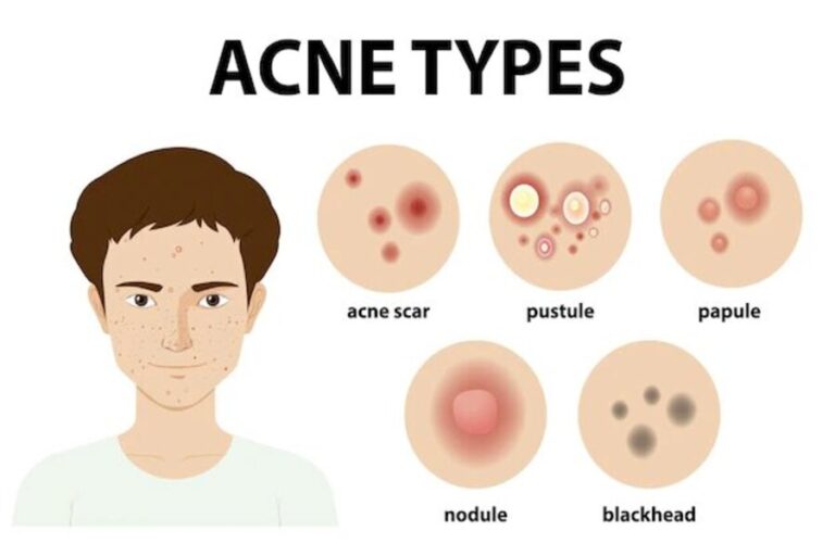 Things you need to know about acne-prone skin: Causes, triggers, and treatment